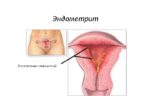 Эндометрит: основные симптомы и лечение
