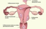 Клиническая картина и лечение субмукозной миоми матки
