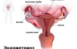 Почему происходит миометрия локальное утолщение