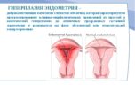 Причины и признаки гиперплазии эндометрия