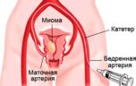 Причины, симптомы и лечение миомы шейки матки