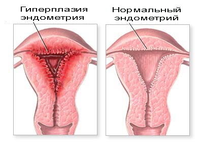 Что такое эндометрий пролиферативного типа