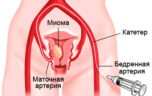 Лечение узловой миомы матки