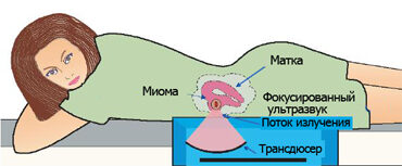 Миома матки: виды операций