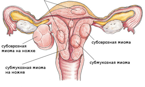 Как проводится диагностическое выскабливание полости матки при миоме?